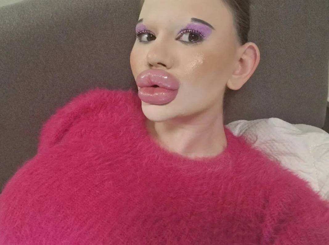 Dudak estetiğine harcadığı para 'dudak' uçuklattı 6